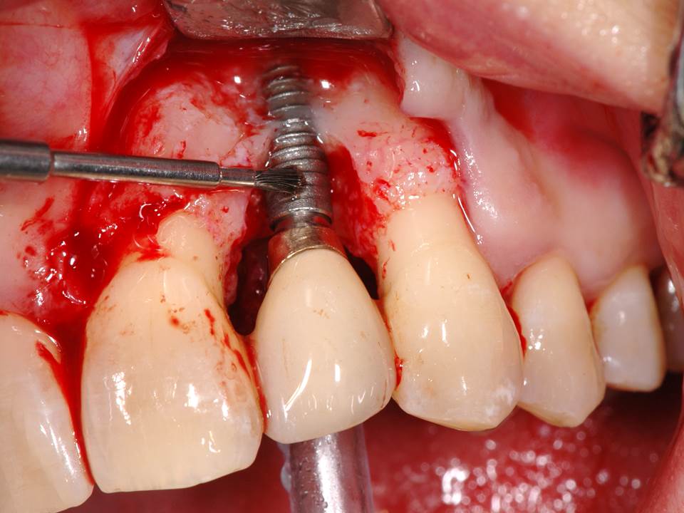 Abb. Periimplantitis
